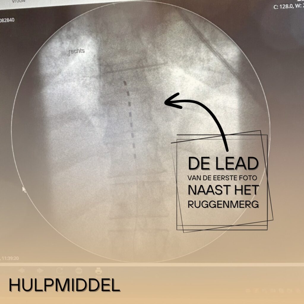 Foto van plaatsing lead
