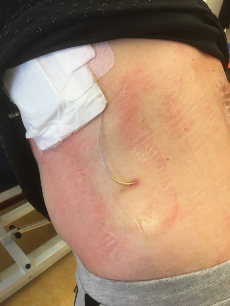 Foto proefplaatsing neurostimulator